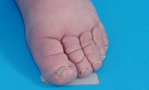 Lymphdrainage - Indikation Stemmer Zeichen Lymphdrainage - Indikation Stemmer Zeichen